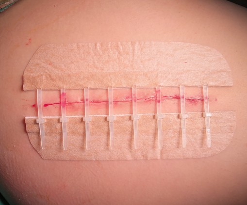 立辰全球首创第一代皮肤表面缝合技术，能避免常规针线缝合时带来的皮肤缝合创伤、缝线异物刺激，近20年临床验证。