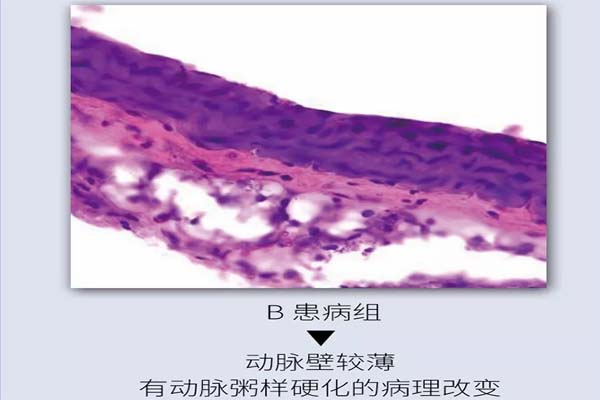 褐藻糖胶有助于治疗与预防动脉粥样硬化_3