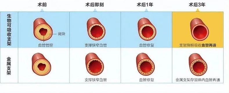 支架对比