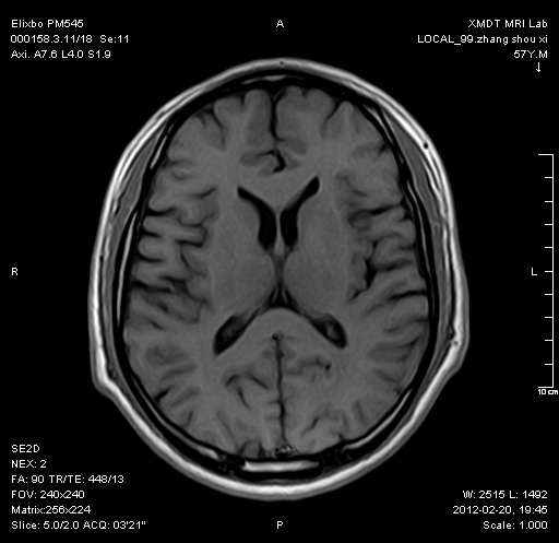 颅脑-Axi-SE2D-T1WI