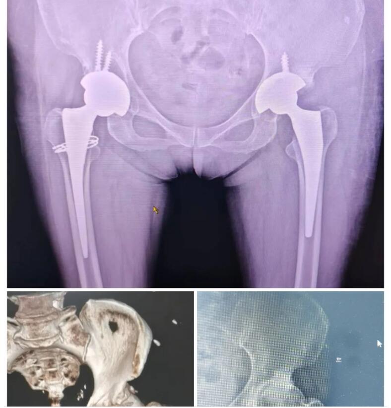 我院骨外科團(tuán)隊(duì)為患者施行左側(cè)全髖關(guān)節(jié)人工置換術(shù)，讓患者重新健康走路