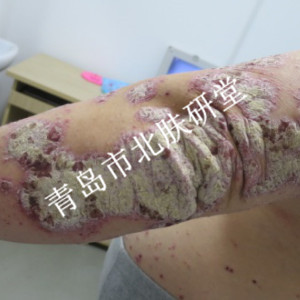 患者曹先生