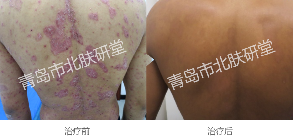 青岛治疗银屑病