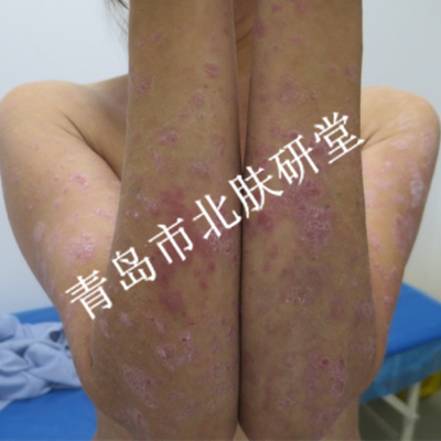 患者国女士