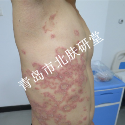 患者李先生