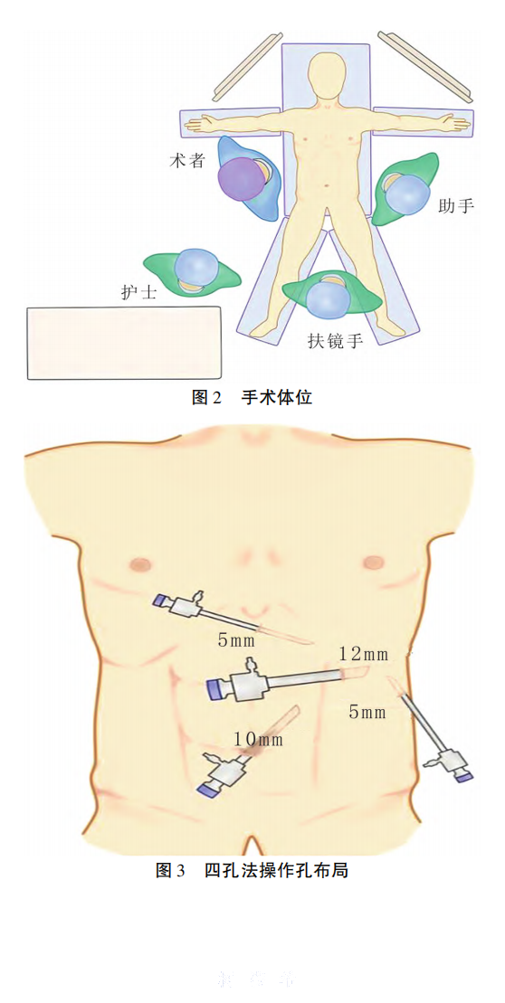 腹腔镜脾部分---图2图3