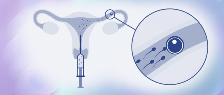 IUI Catheter