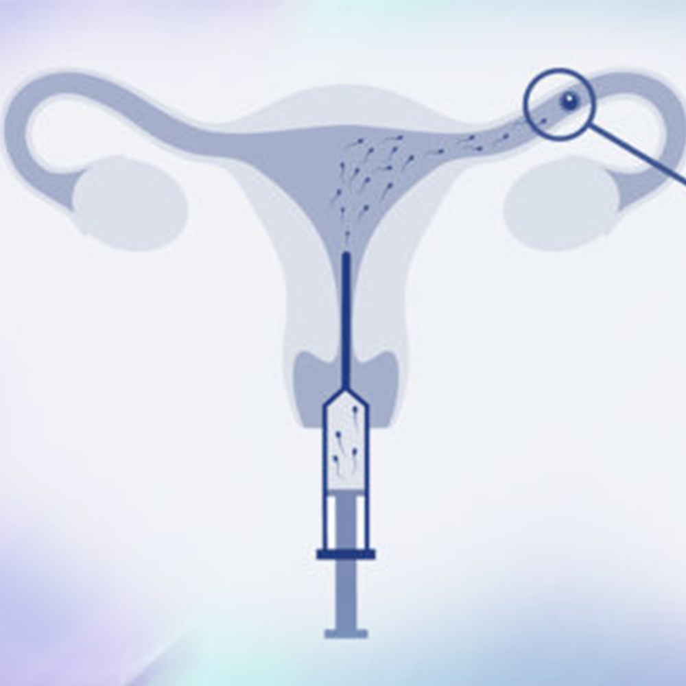 IUI Catheter (2)