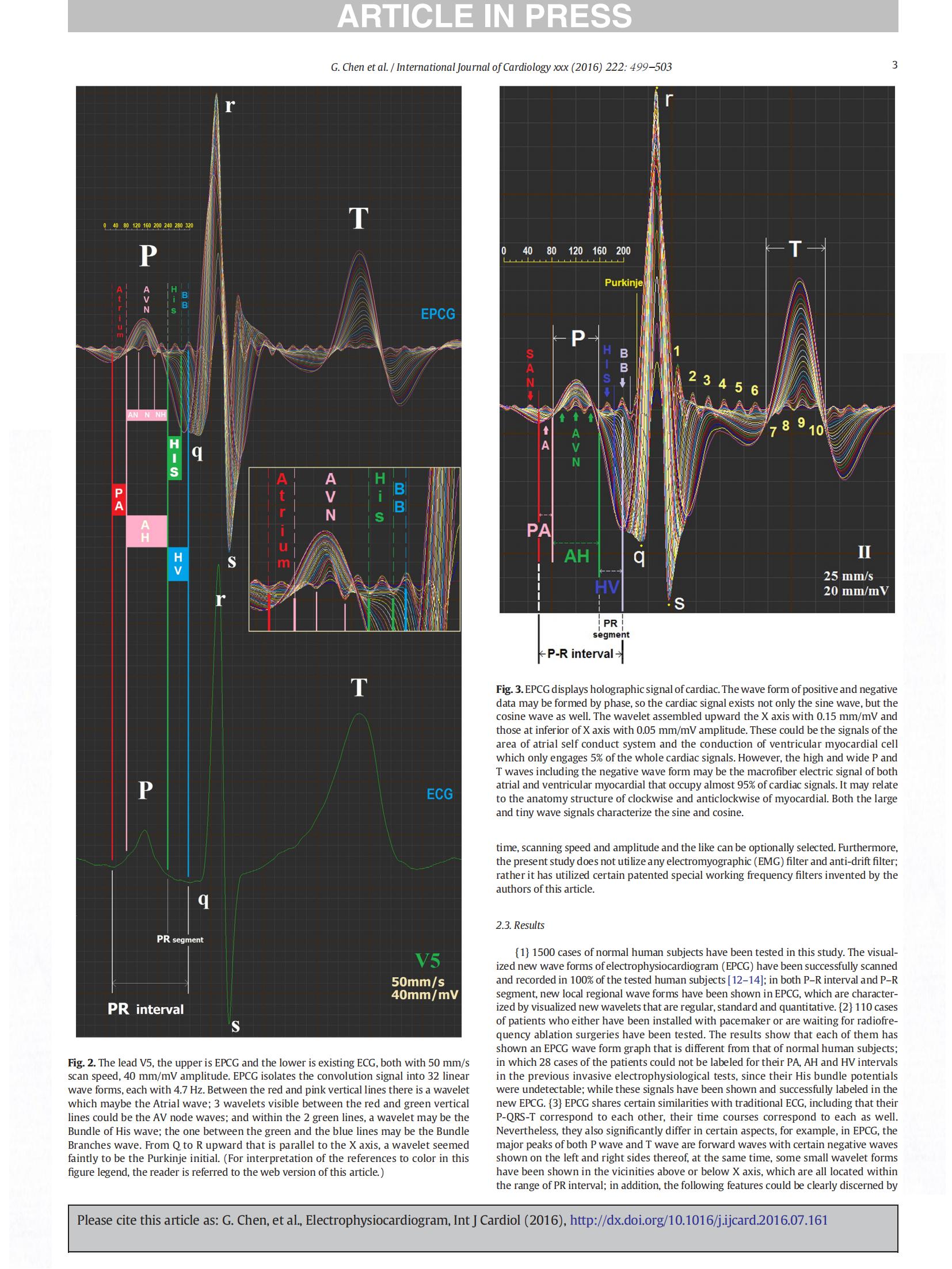 Electrophysiocardiogram For the first time EPCG has been recorded on human body surface_02