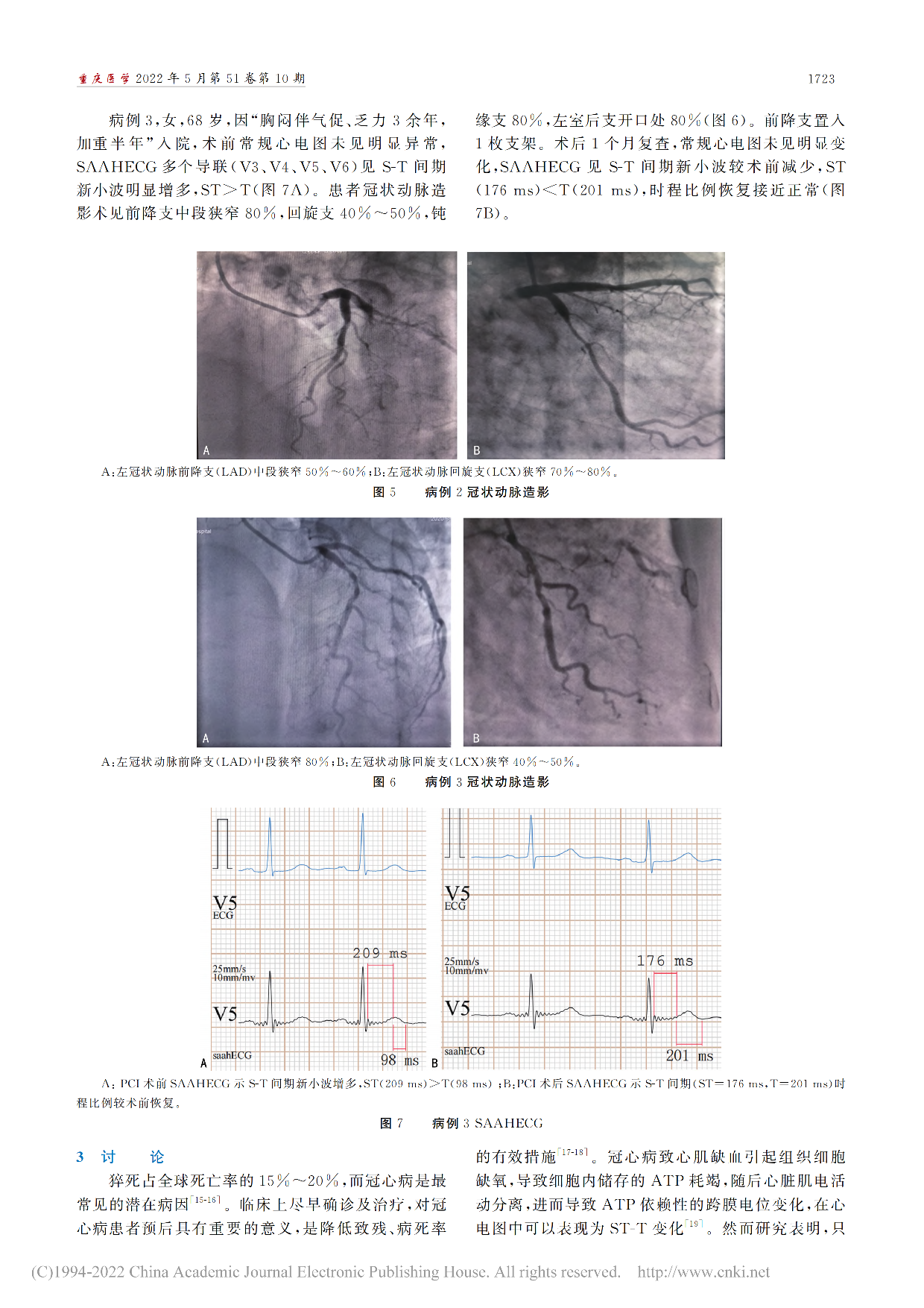 SAAHECG对冠心病的诊...冠状动脉狭窄程度的关系探讨_廖芯_04