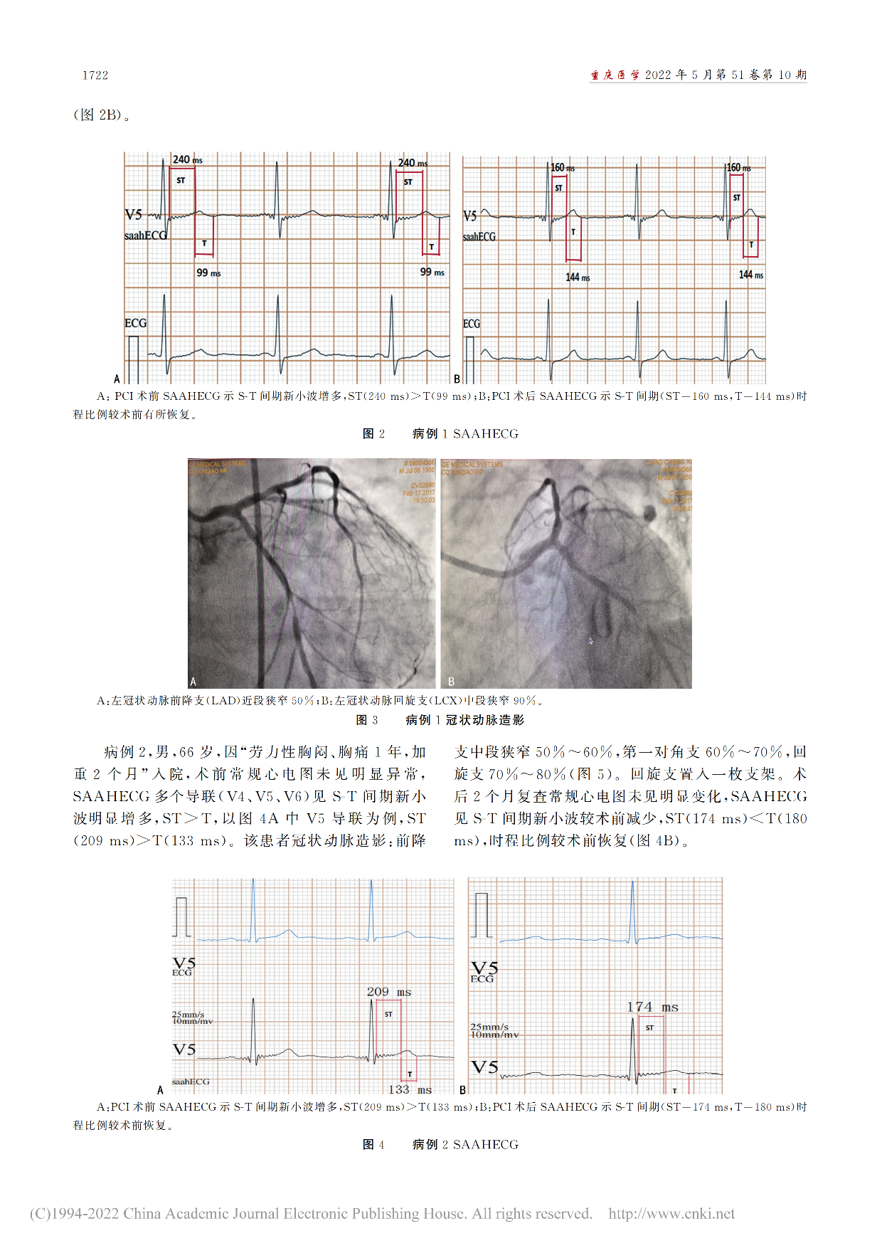 SAAHECG对冠心病的诊...冠状动脉狭窄程度的关系探讨_廖芯_03