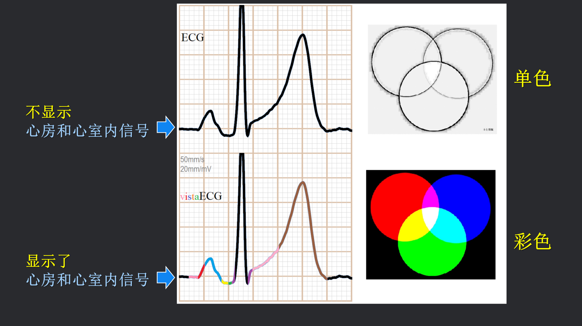 vistaECG新ECG en_04