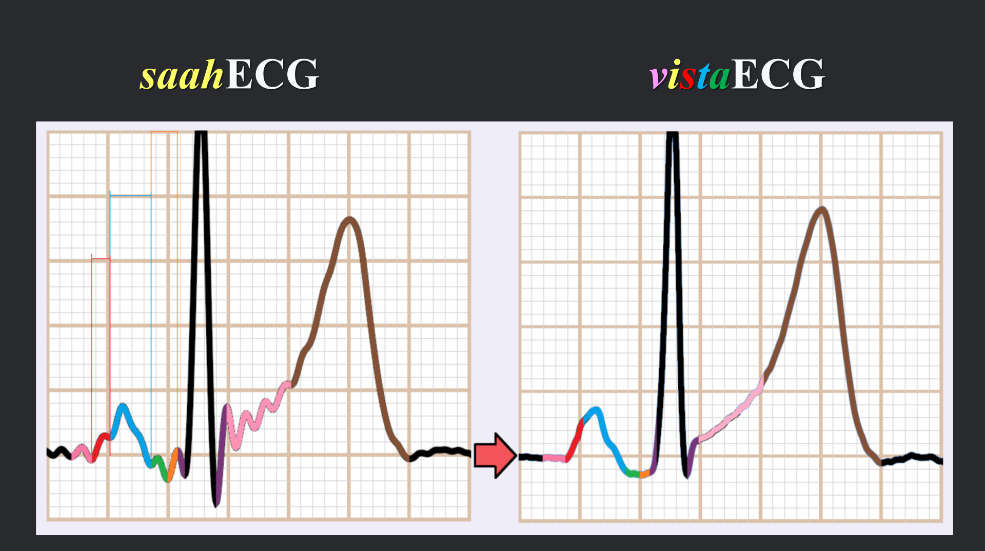 vistaECG新ECG en_07