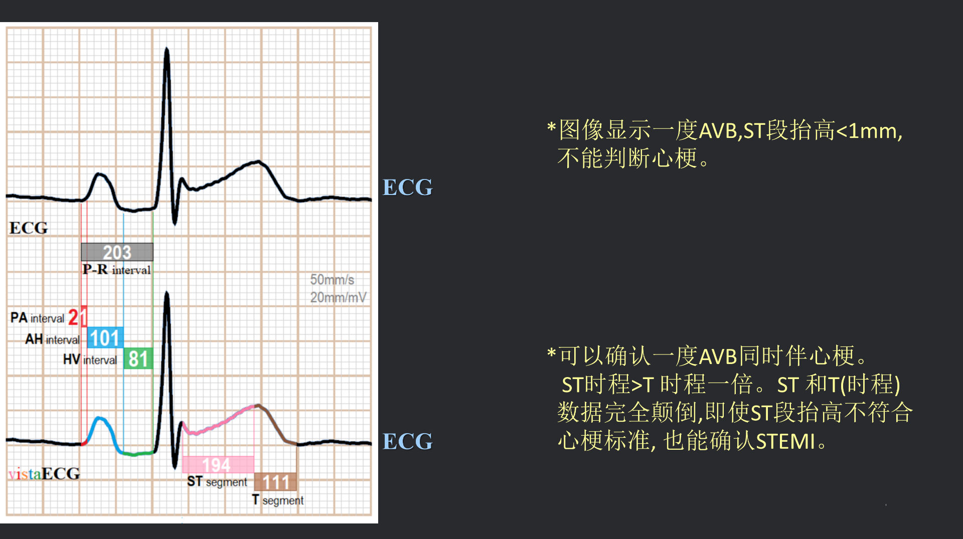 vistaECG新ECG en_39