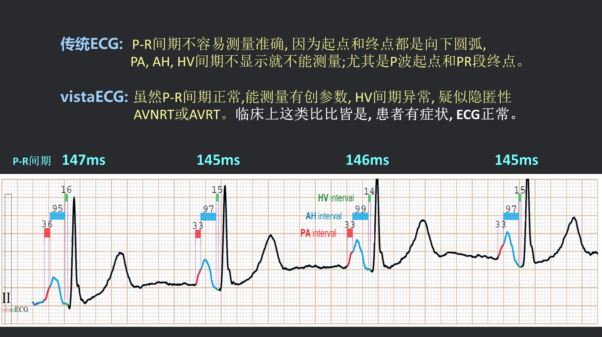 vistaECG新ECG en_41