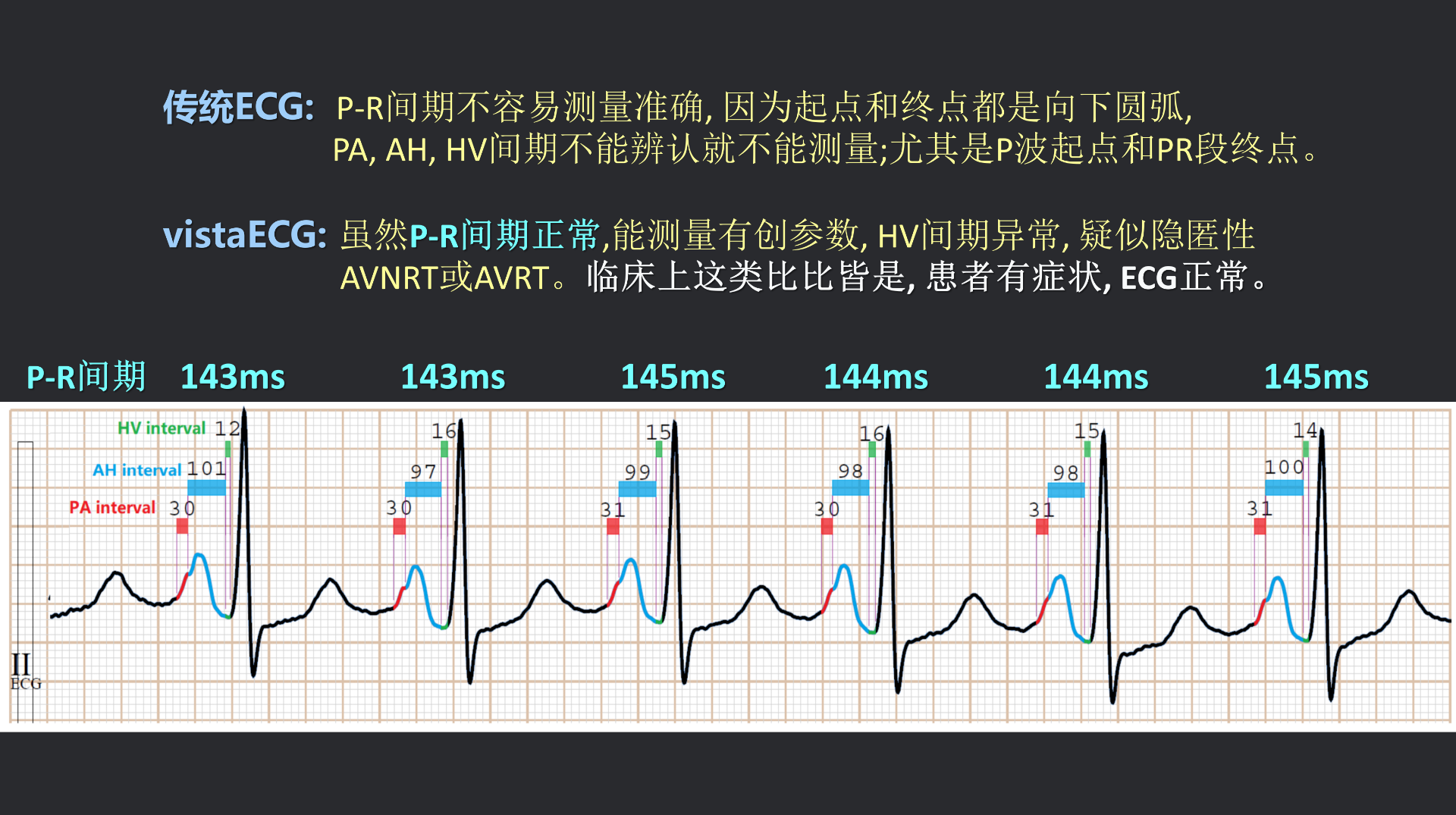 vistaECG新ECG en_42