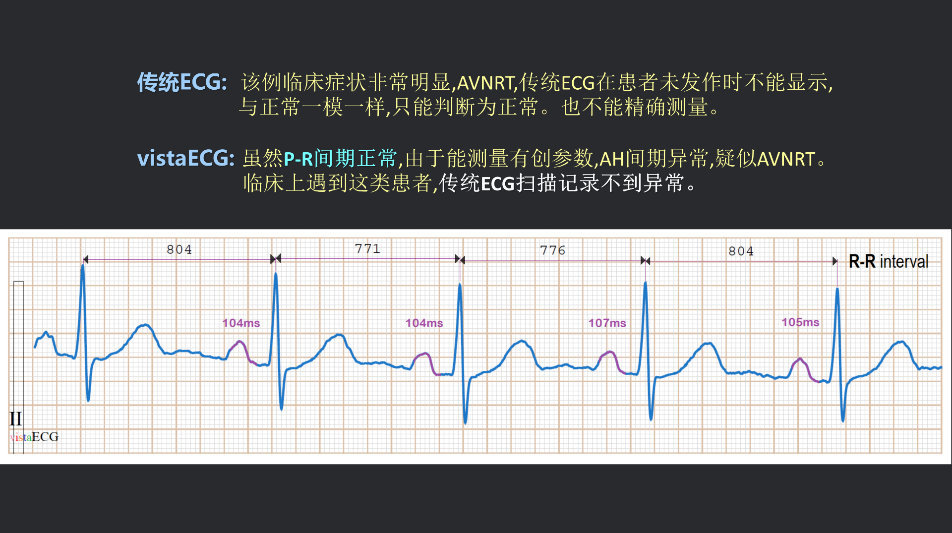 vistaECG新ECG en_43