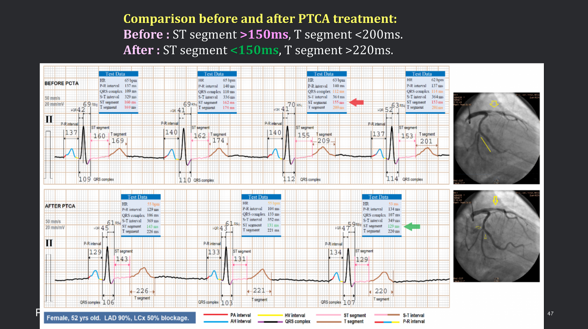 vistaECG新ECG en_47