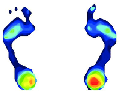 Plantar-pressure-distribution-map-obtained-from-pedographic-analysis_20250113_17367362890152540