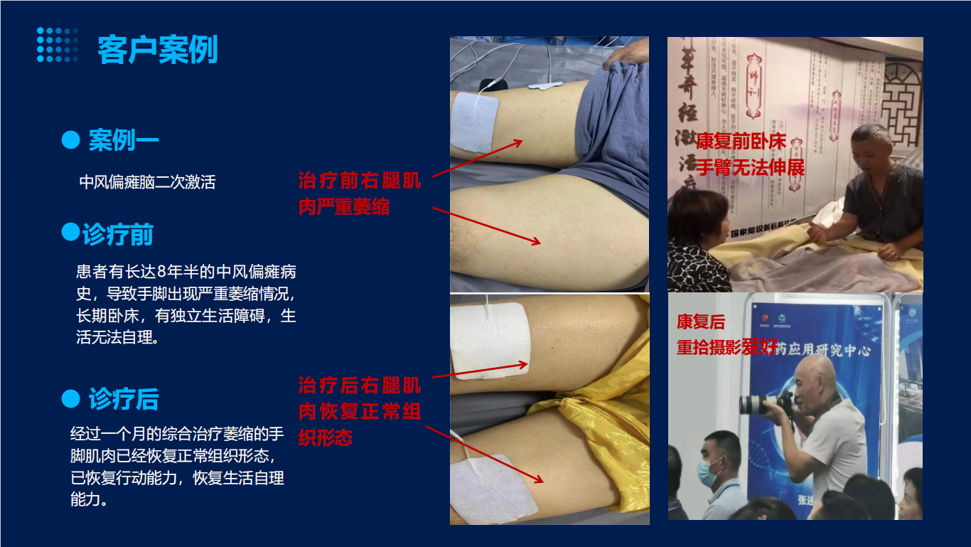 诊疗前：患者有长达8年半的中风偏瘫病史，导致手脚出现严重萎缩情况，长期卧床，有独立生活障碍，生活无法自理。 治疗前右腿肌肉严重萎缩
诊疗后：
经过一个月的综合治疗萎缩的手脚肌肉已经恢复正常组织形态，已恢复行动能力，恢复生活自理能力。