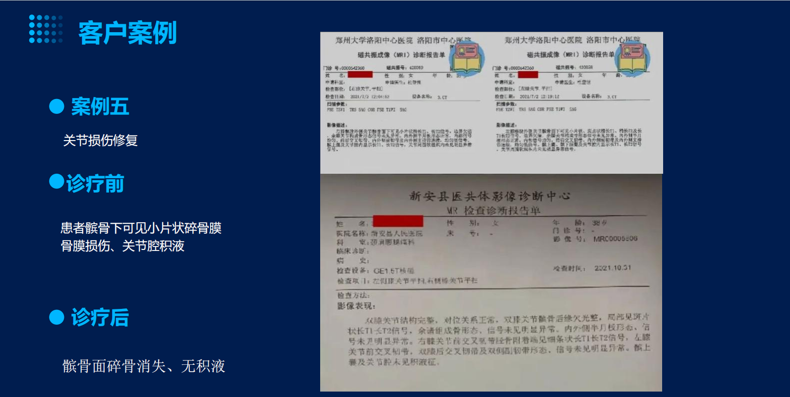 诊疗前
患者髌骨下可见小片状碎骨膜，骨膜损伤、关节腔积液
诊疗后
髌骨面碎骨消失、无积液