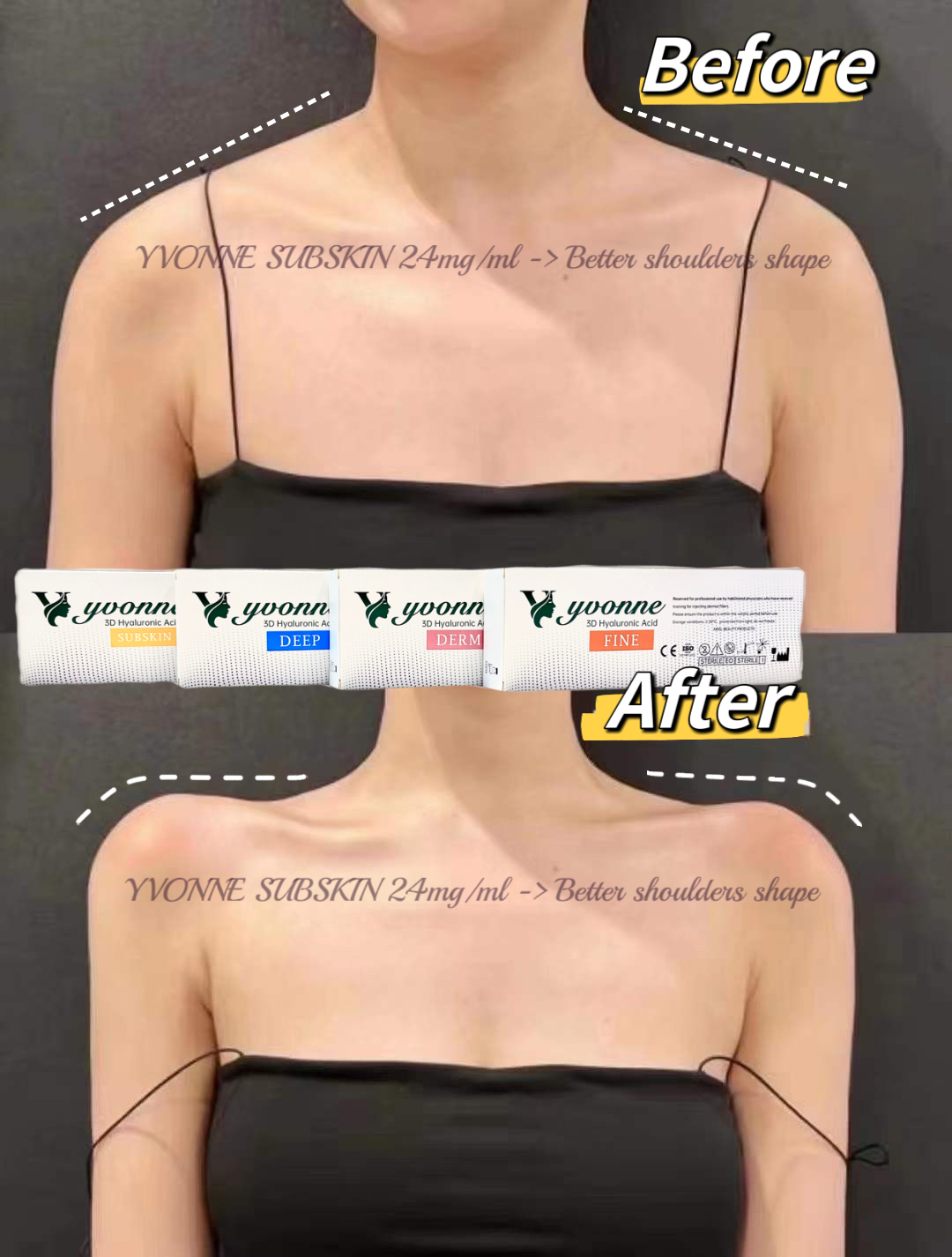 SUBSKIN