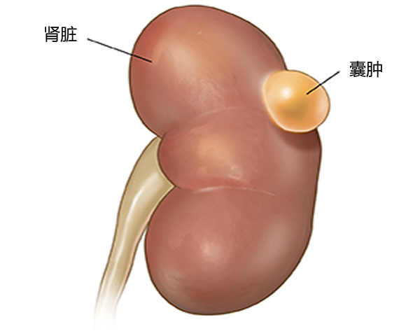 体检发现肾囊肿怎么办？