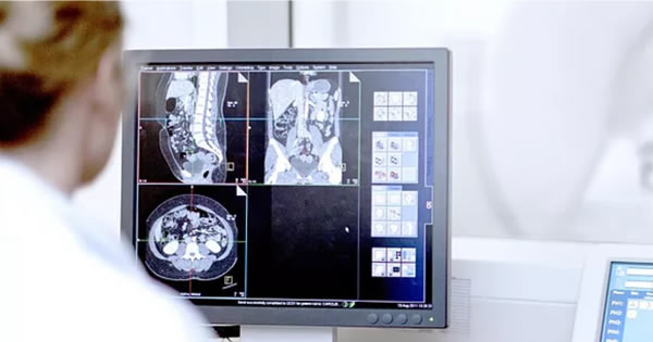 为什么诊断肝癌一定要做强化CT?肝癌的CT表现有哪些?