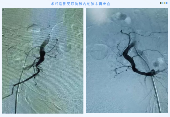 膀胱动脉造影图图片