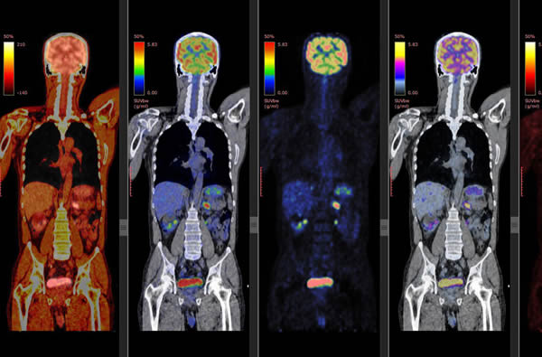 PET/CT实现了对恶性肿瘤早期、分子水平的准确性和定位诊断
