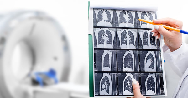 肺部CT检查