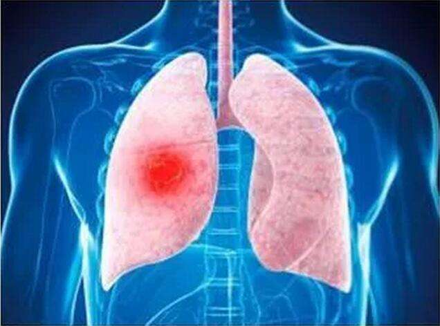 肺癌10.jpg