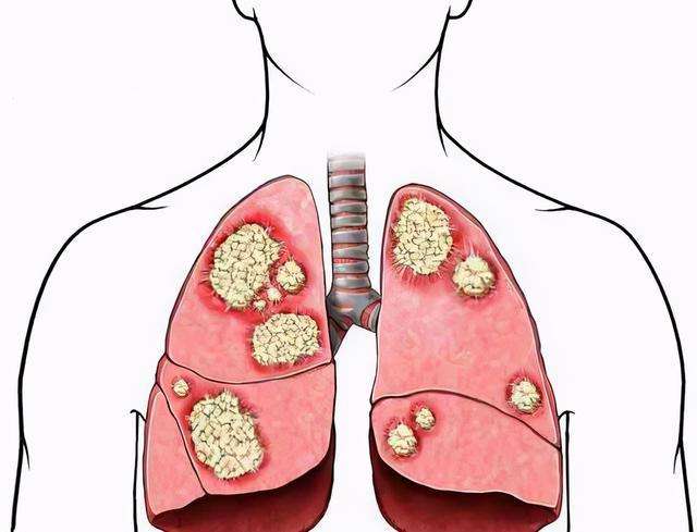 肺部纤维化.jpg