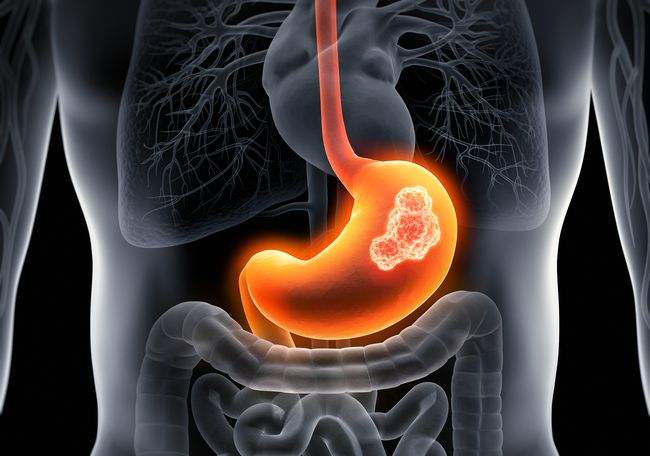 胃肠间质瘤.jpg