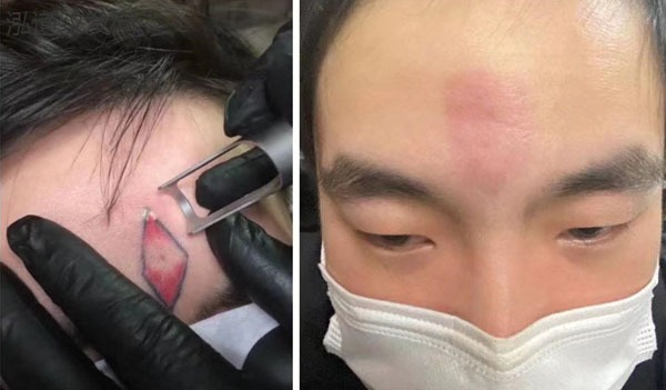 洗纹身案例效果图12