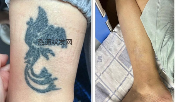 洗纹身案例效果图10