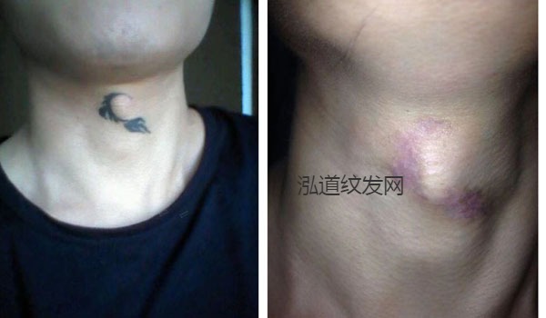 洗纹身案例效果图5