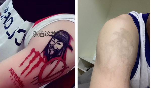 皮秒激光洗纹身3