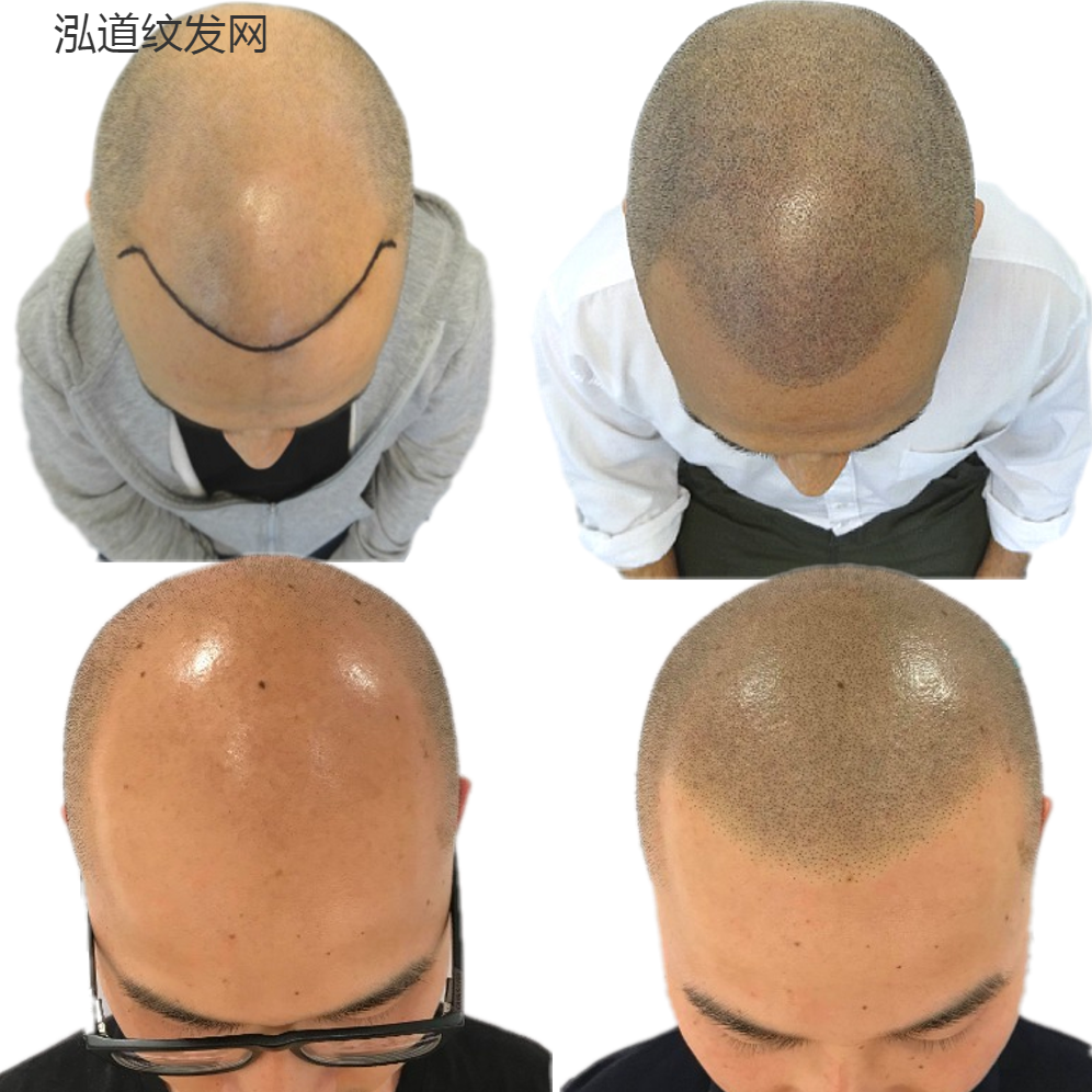 秃头谢顶形象定制 一遇“纹发”定终身