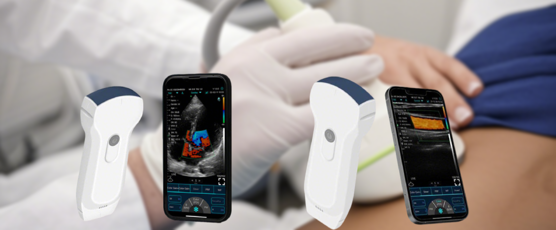 The pocket ultrasound can serve as an auxiliary tool in the operating room to help doctors determine the surgical site and examine the surgical outcome. For instance, in liver resection surgery, the handheld ultrasound diagnostic device can be used to check whether the resected area is complete.