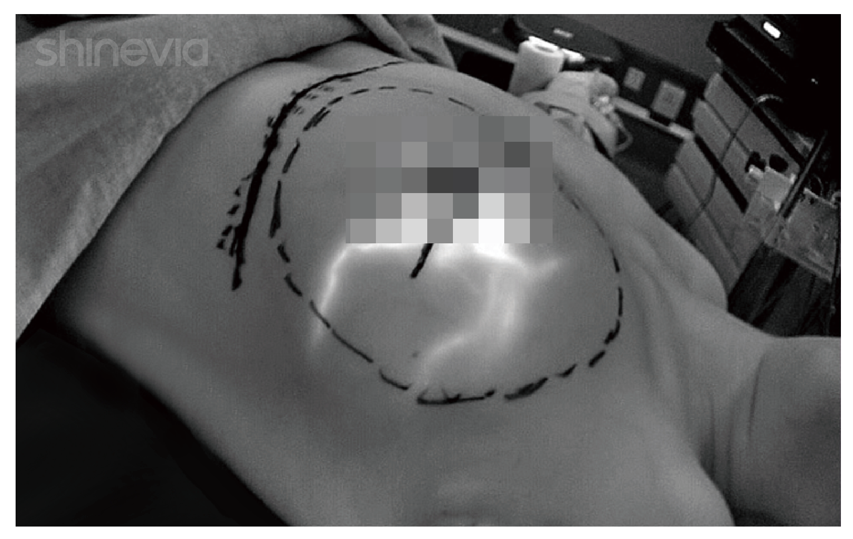 Methylene blue (US Blue MB) sentinel lymph node tracking