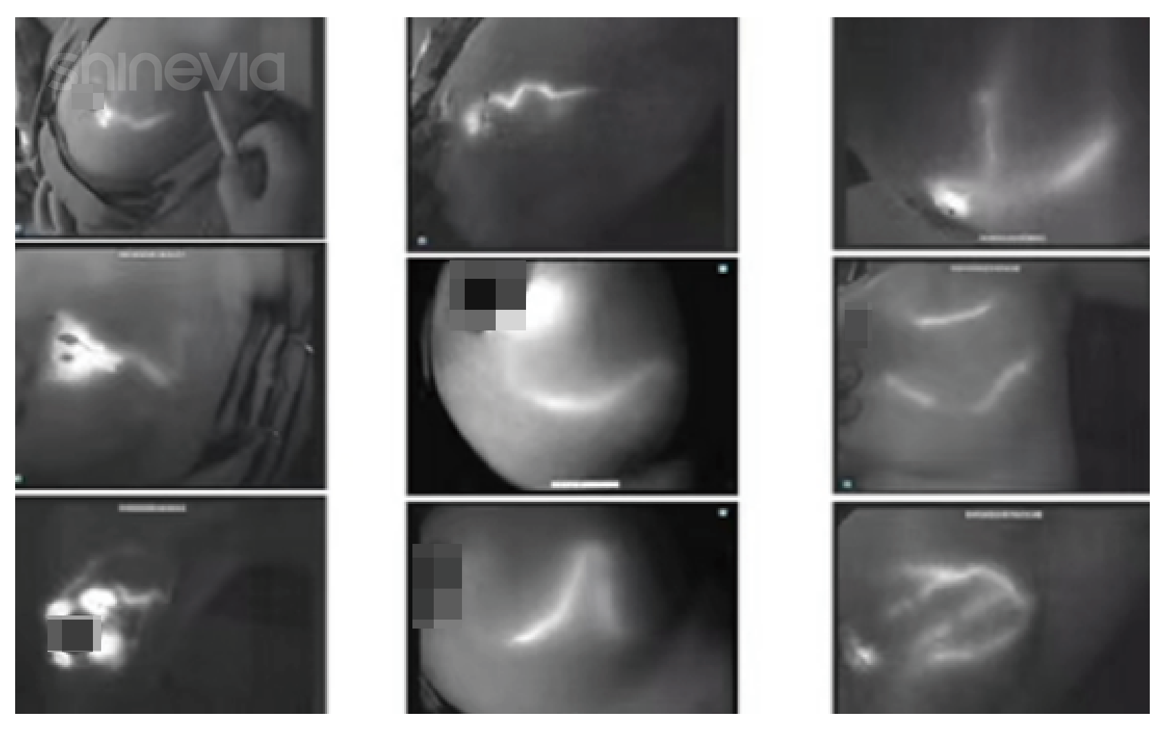 Indocyanine Green (ICG) sentinel lymph node tracking