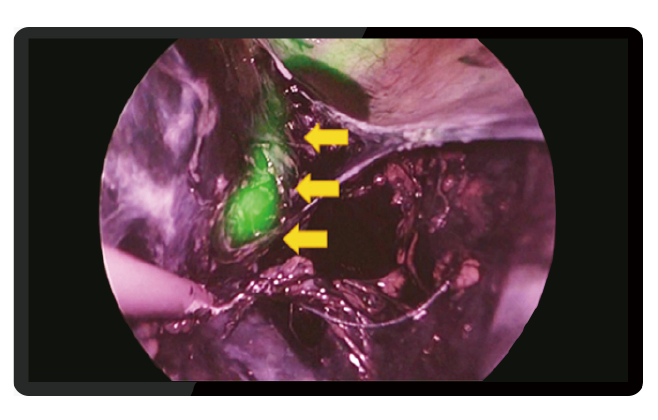 Prophylactic use of a fluorescent ureteral catheter can reduce the risk of ureteral injury by visualizing the ureter, especially in patients with ureteral malformations due to severe adhesions or uterine enlargement and is suitable for surgeons who lack laparoscopic surgery experience.
