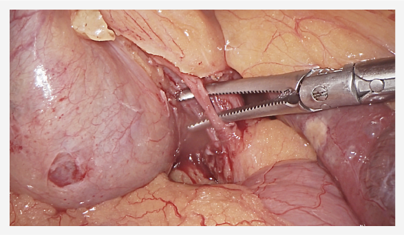 Cholecystectomy