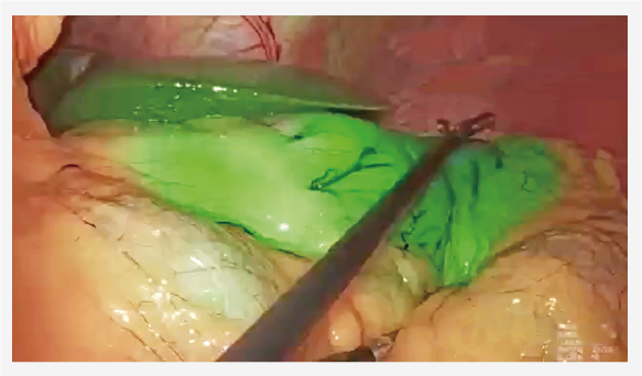 Fluorescence intraoperative localization and navigation of gastric tumors