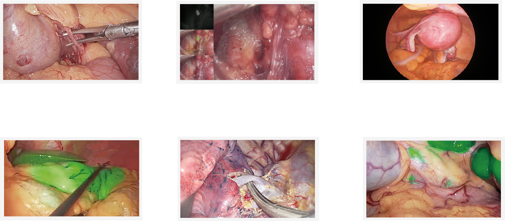 Thyroid tumor removal